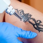 these pictures serve as a warning about using tattoo removal cream these pictures serve as a warning about using tattoo removal cream