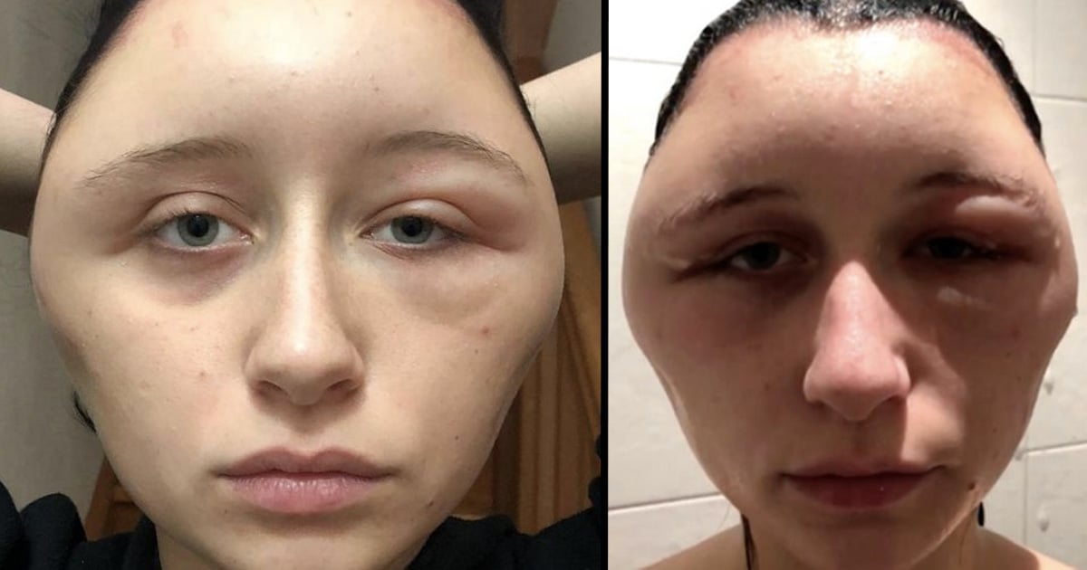 Woman's Head Doubles in Size After Allergic Reaction to ...